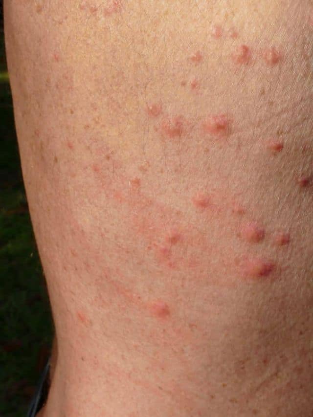 Bed Bug Bites Pictures, Symptoms, Treatment, and Prevention