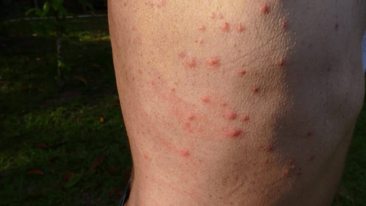 Bed Bug Bites Pictures Symptoms Treatment And Prevention Bed Bug Bites Pictures Symptoms Treatment And Prevention
