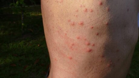 Marks of bed bug bites on skin