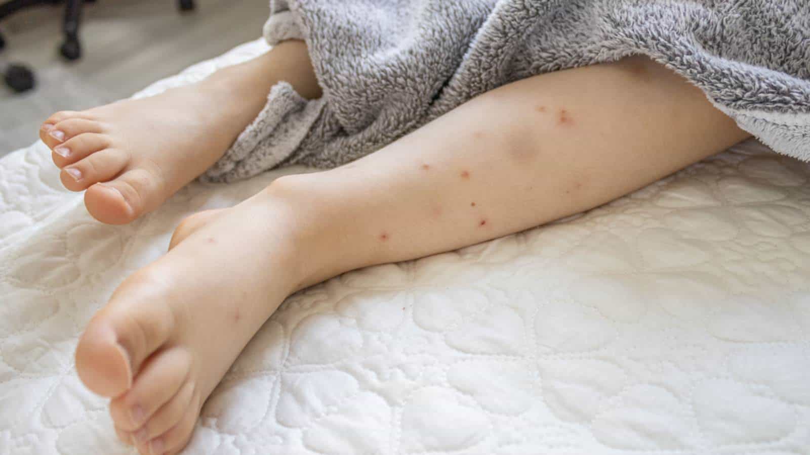 Childโs leg with bed bug bites