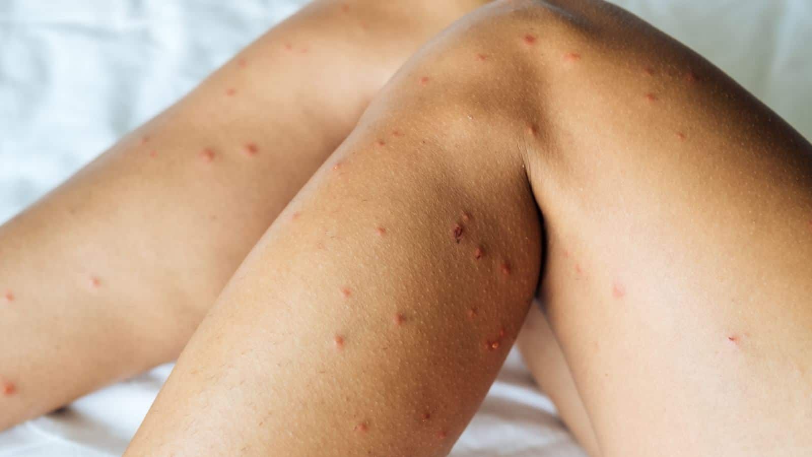 Rashes on legs due to bed bug bites