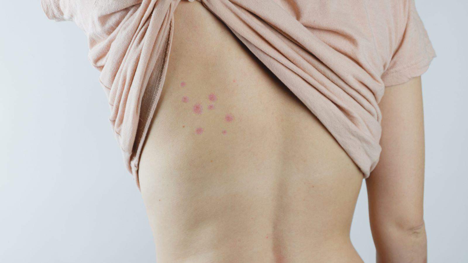 Back of woman with bed bug bites