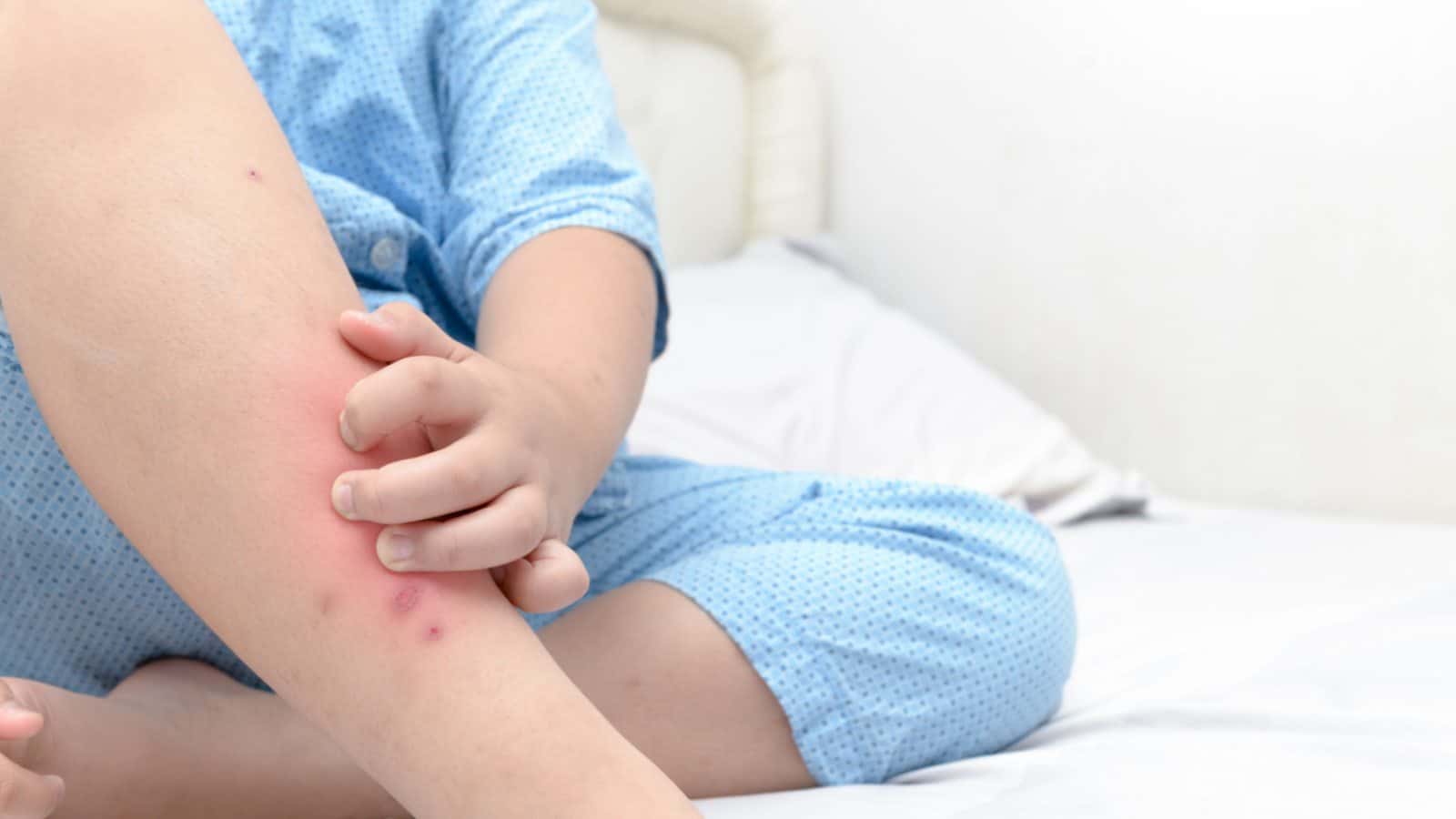 Little boy scratching legs due to bed bug bites