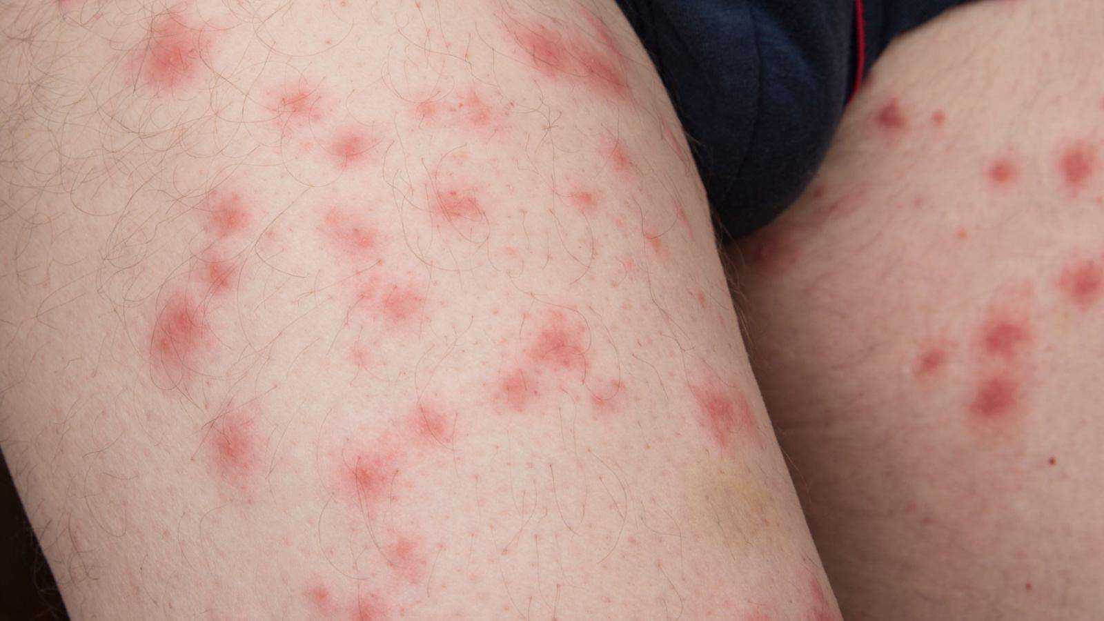 Red rashes from bed bug bites on leg