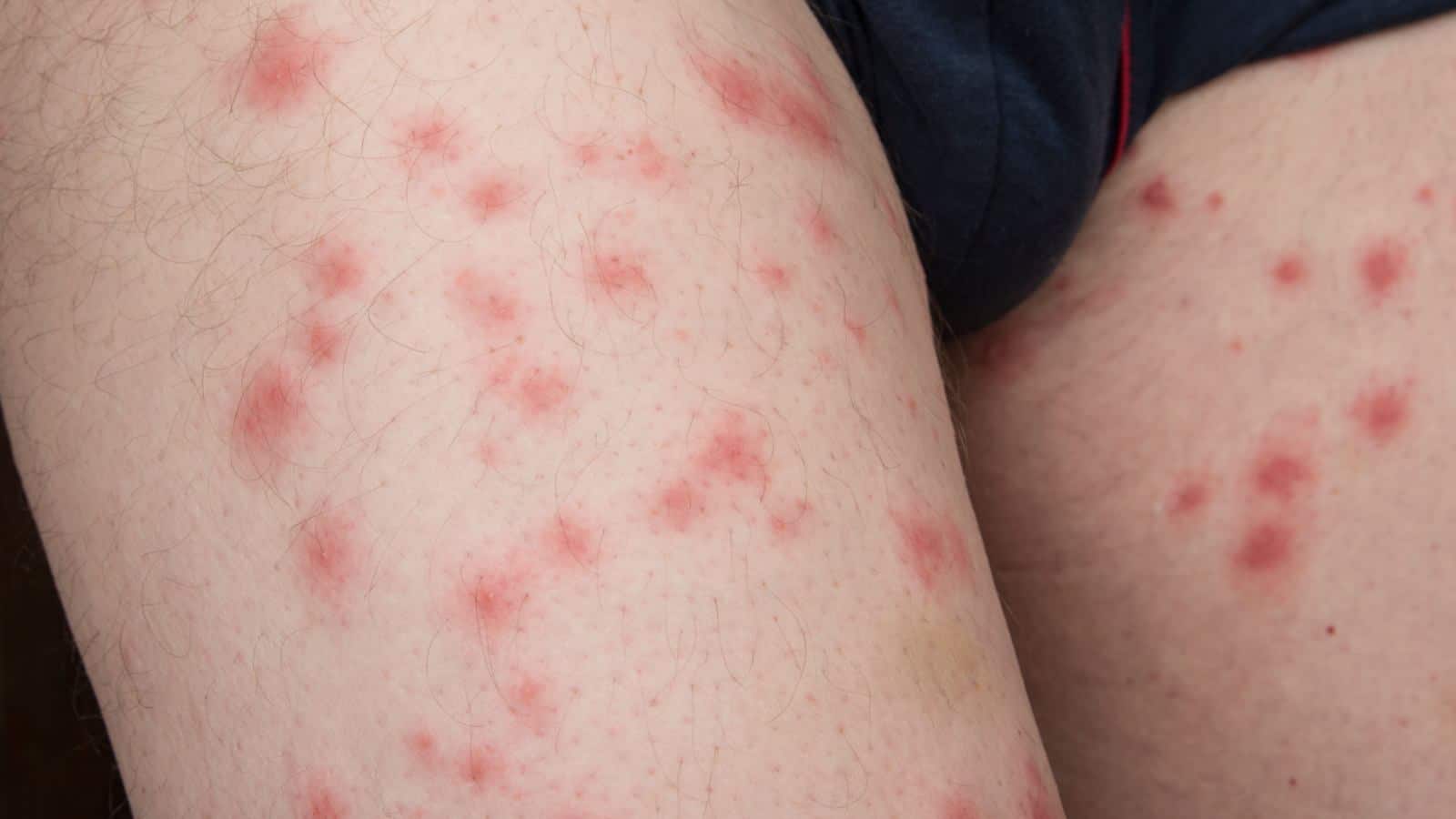 Bed bug bites on legs