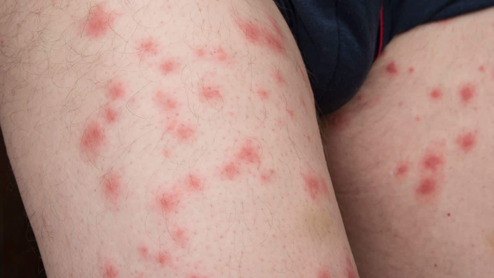 Bed bug bites on male legs