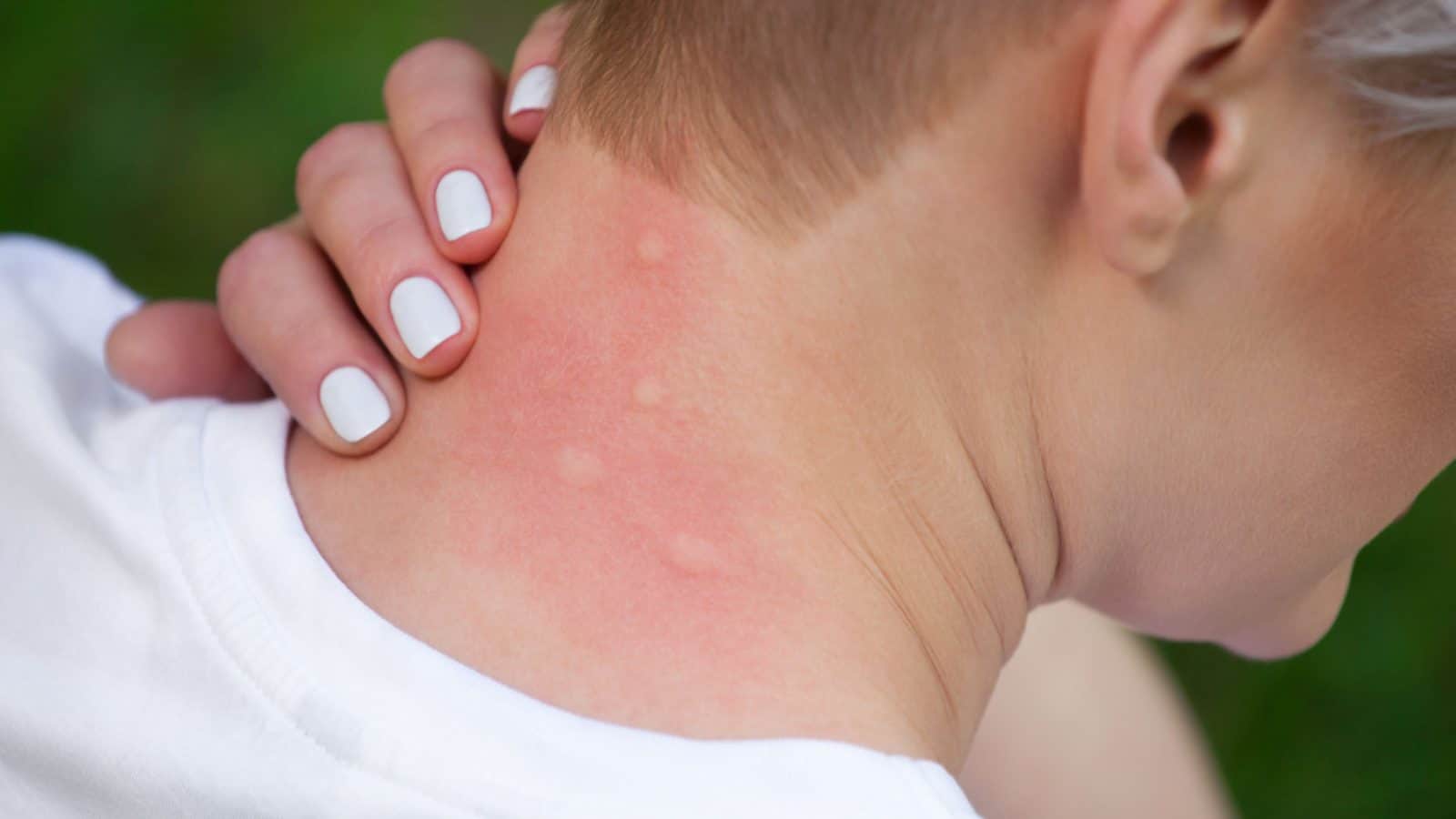 Neck with mosquito bites