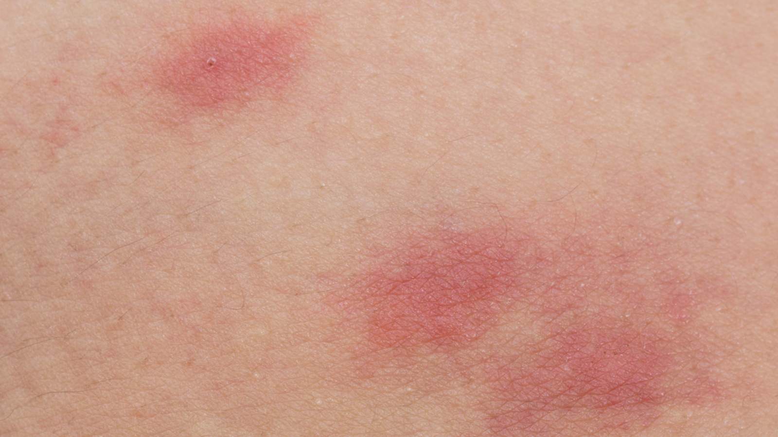 Flea bites on skin