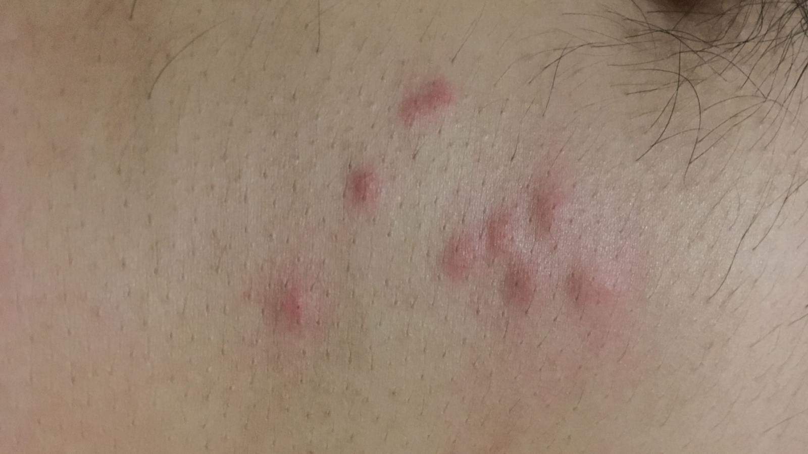 Bed bug bites on stomach