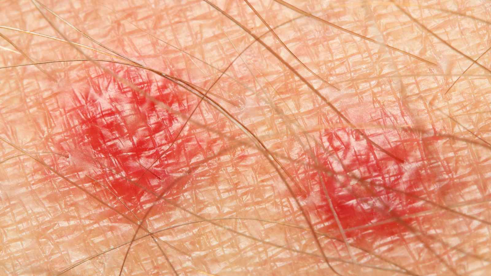 Closeup view of swollen bed bug bites