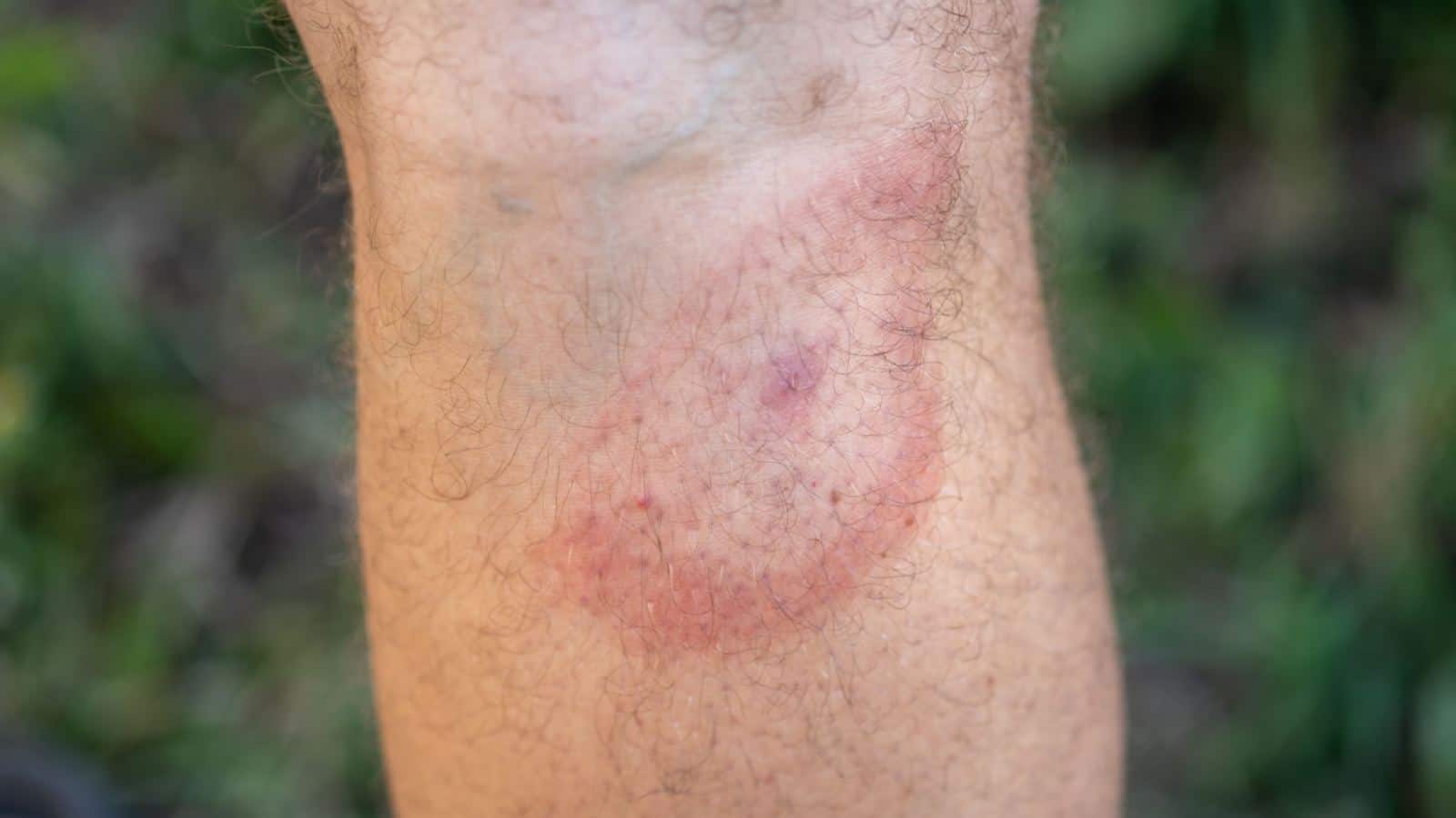 Tick bite with a red ring