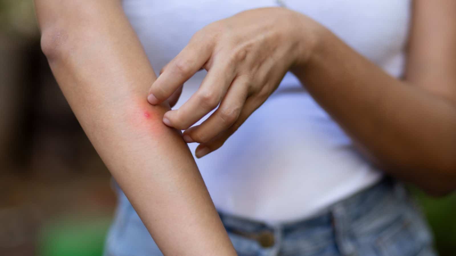 Woman itching a spider bite