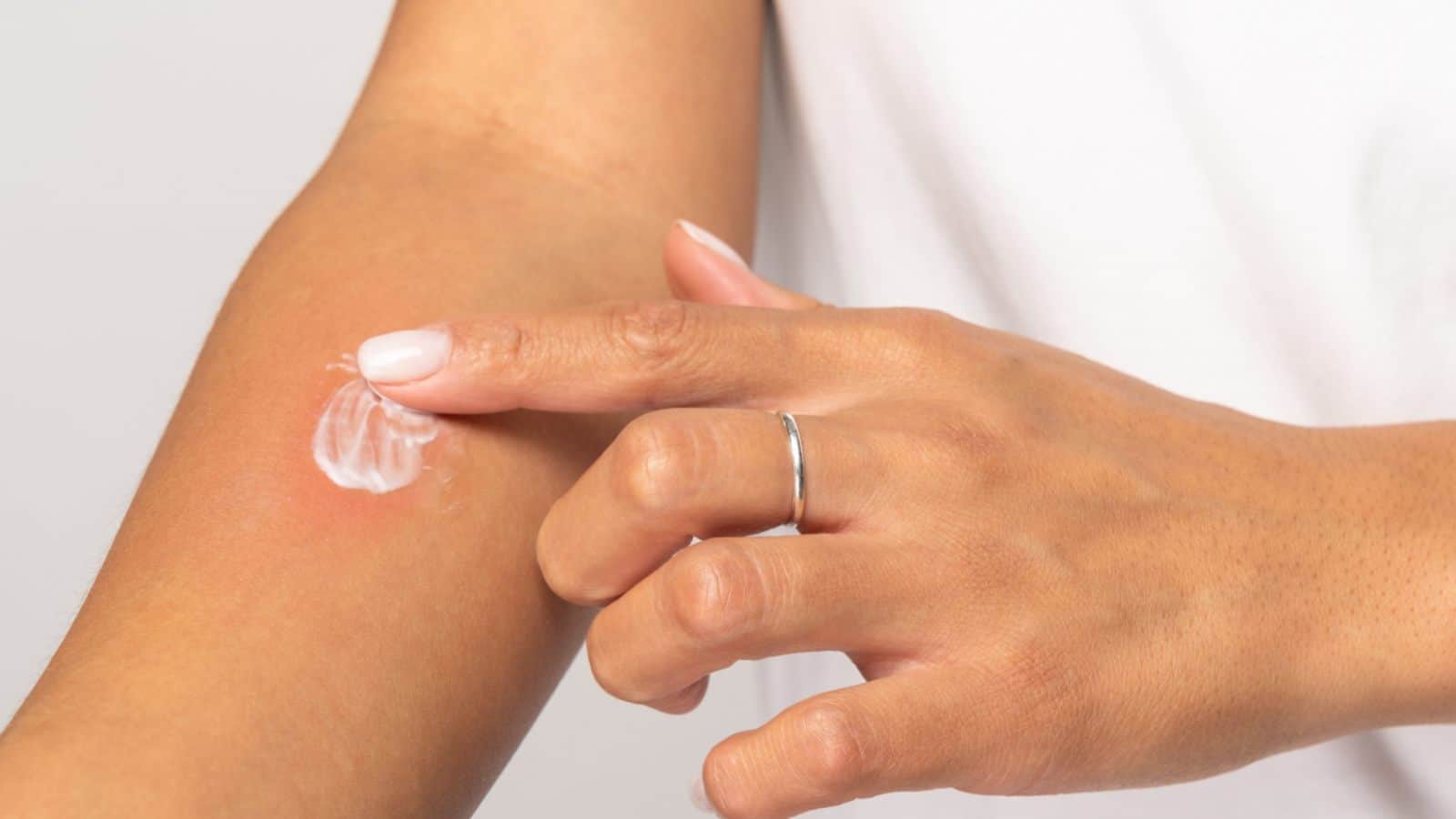 Applying cream to spider bite