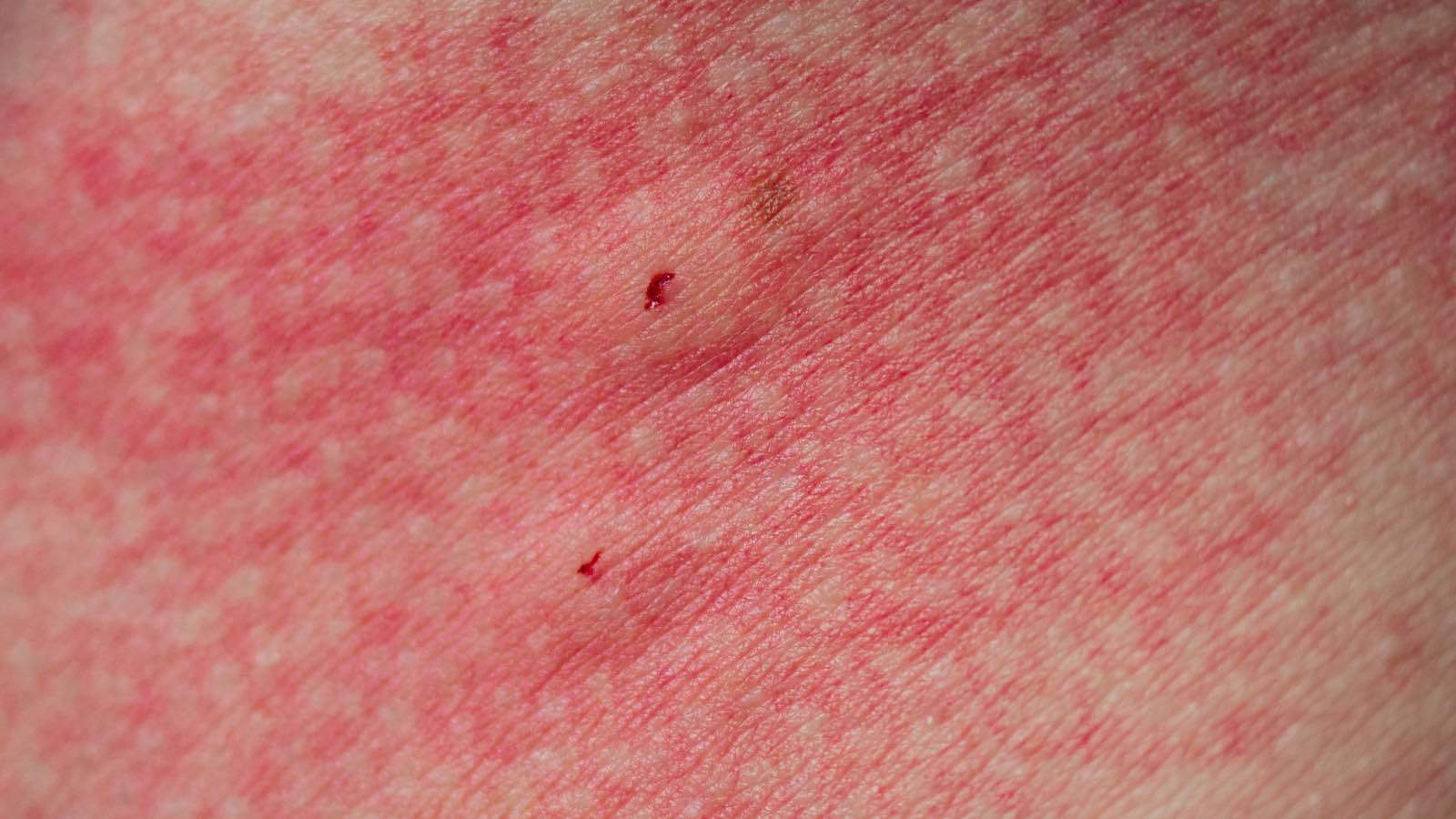 Spider Bite