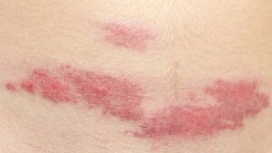 No See Ums: What They Are and How to Get Rid of Them